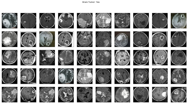 Brain Tumor